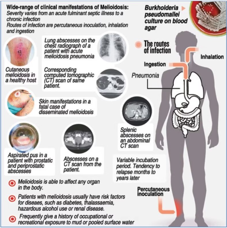 Широкий спектр клинических проявлений мелиоидоза (на англ.яз.) https://medstudentnotes.com/microbiology-public-health/melioidosis/